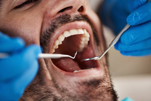 Best Emergency Wisdom Tooth Extraction in Memphis, MO