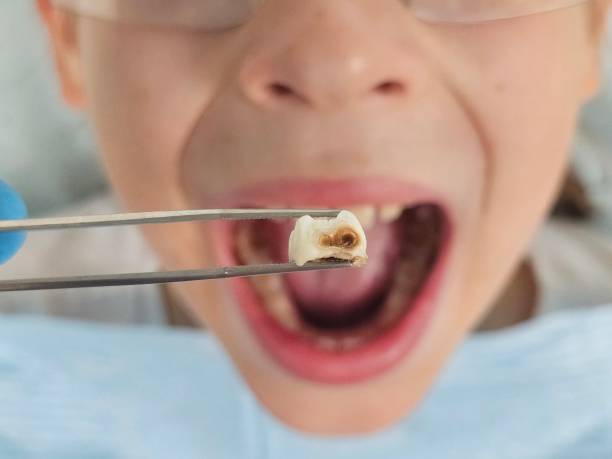 Best Broken or Chipped Tooth Repair in Memphis, MO
